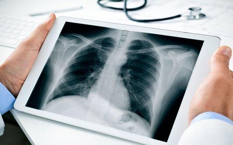 26,000 new lung cancer patients diagnosed in Vietnam annually